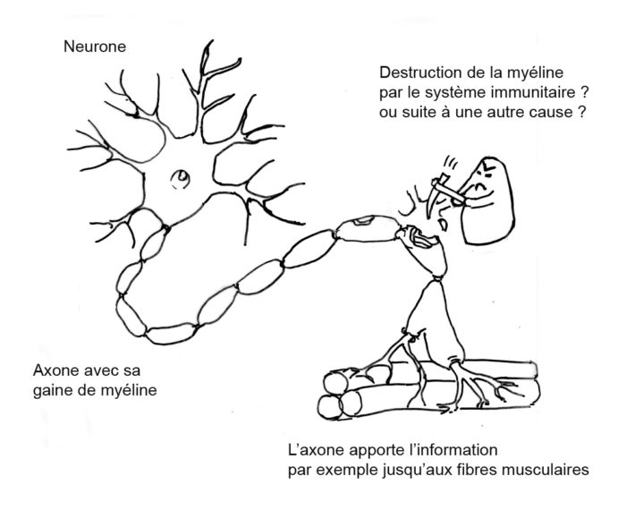 Qu’est ce que la sclérose en plaques ?